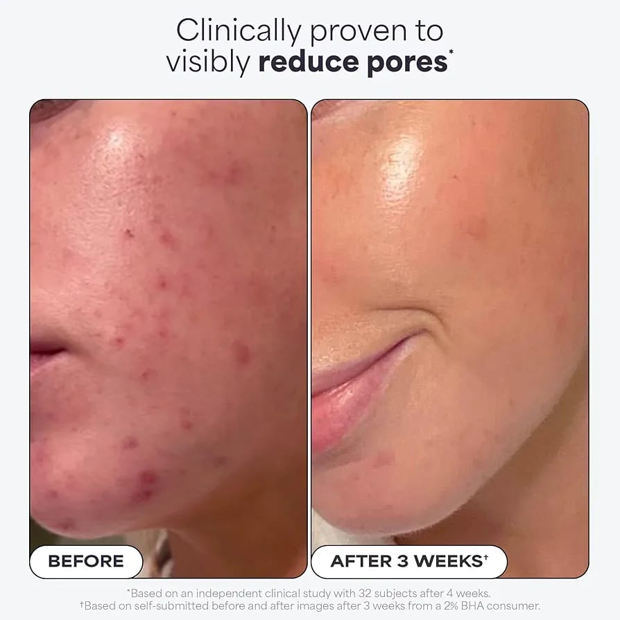 Paula's Choice 2% BHA Liquid Exfoliant 118ml – Salicylic Acid Leave-On Exfoliator for Blackheads, Pores & Smooth Skin JZCosmetics.com