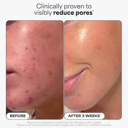Paula's Choice 2% BHA Liquid Exfoliant 118ml – Salicylic Acid Leave-On Exfoliator for Blackheads, Pores & Smooth Skin JZCosmetics.com